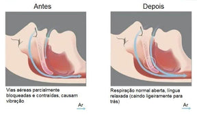 Protetor Bucal para Bruxismo, Ronco e Apneia